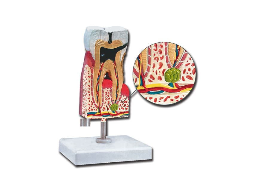 Lower molar cu caries - produs medical pentru oferta ZESCORP
