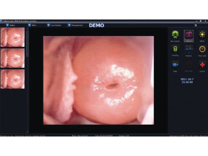 Software pentru LED video colposcopes (29624-5) - produs medical pentru oferta ZESCORP
