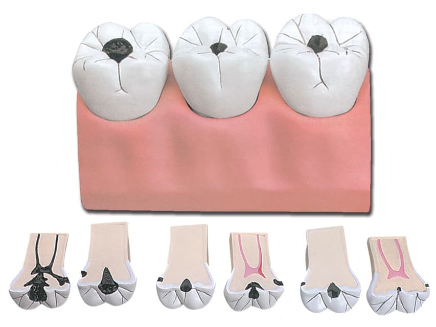 Dental caries - produs medical pentru oferta ZESCORP