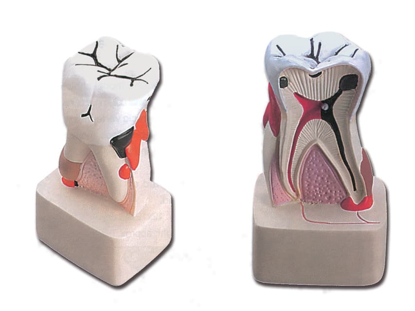 Dental pathology model - produs medical pentru oferta ZESCORP